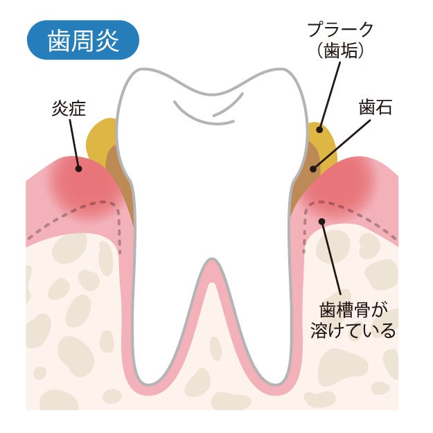 口腔洗浄器で歯周病予防　体の水分が減少しやすい夏は口臭にも要注意！のサブ画像2