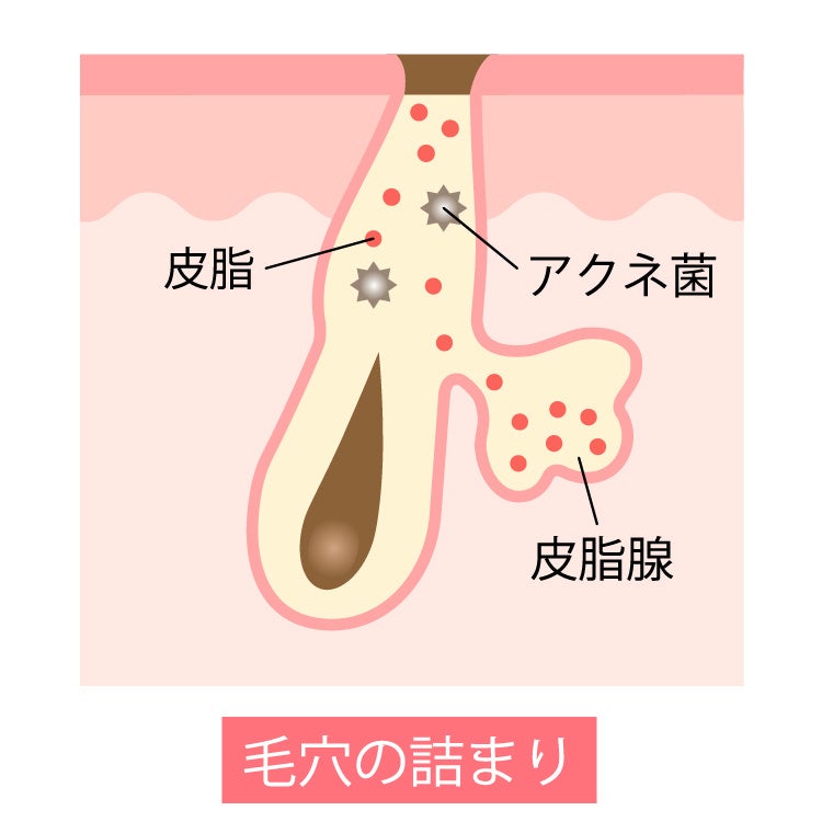 美顔器マニア必見！　クレンジングだけでは落とせない開き毛穴の黒ずみ・汚れに効果がある毛穴吸引のサブ画像2